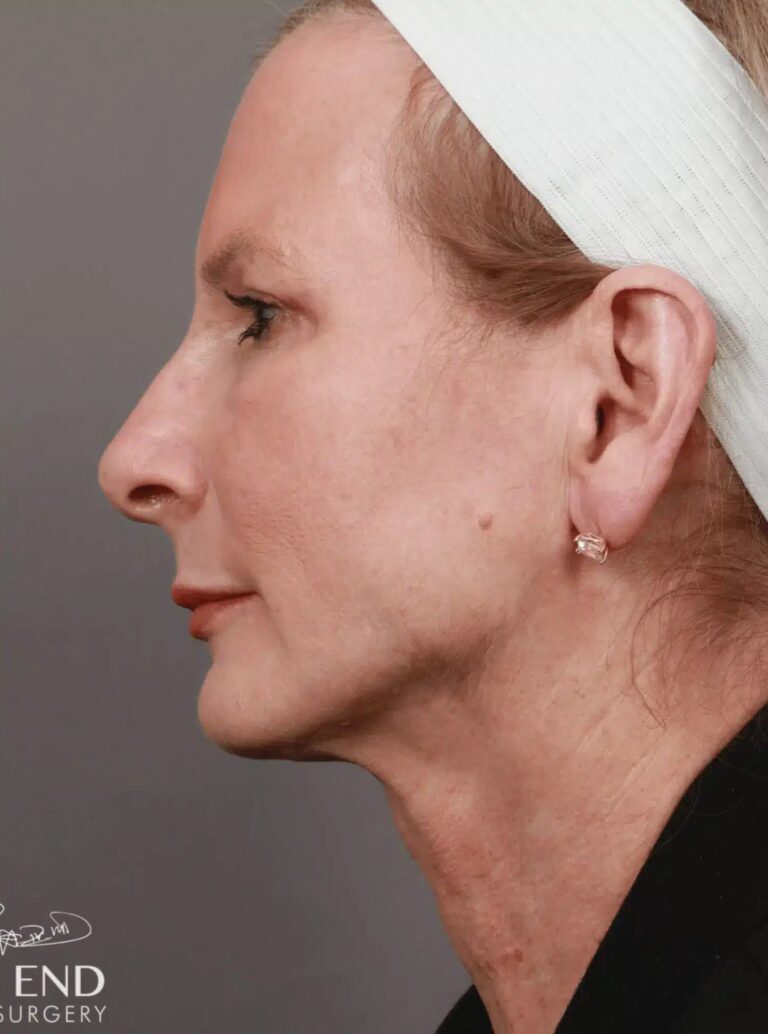 After Image: Renuvion Tightening, Upper Blepharoplasty, CO2 Resurfacing, & Fat Grafting - left-side