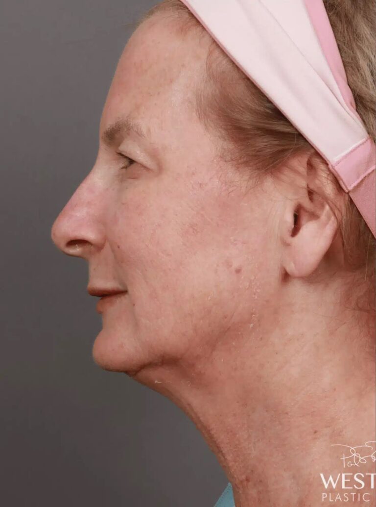 Before Image: Renuvion Tightening, Upper Blepharoplasty, CO2 Resurfacing, & Fat Grafting - left-side