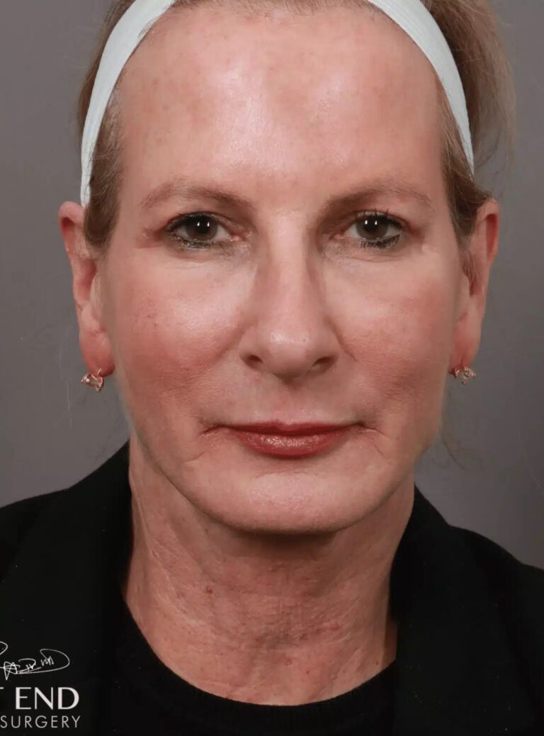 After Image: Renuvion Tightening, Upper Blepharoplasty, CO2 Resurfacing, & Fat Grafting - front