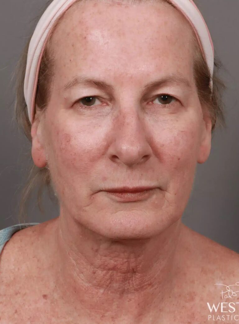 Before Image: Renuvion Tightening, Upper Blepharoplasty, CO2 Resurfacing, & Fat Grafting - front