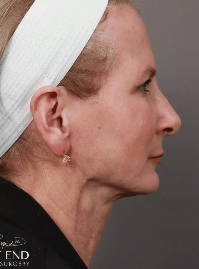 After Image: Renuvion Tightening, Upper Blepharoplasty, CO2 Resurfacing, & Fat Grafting - right-side