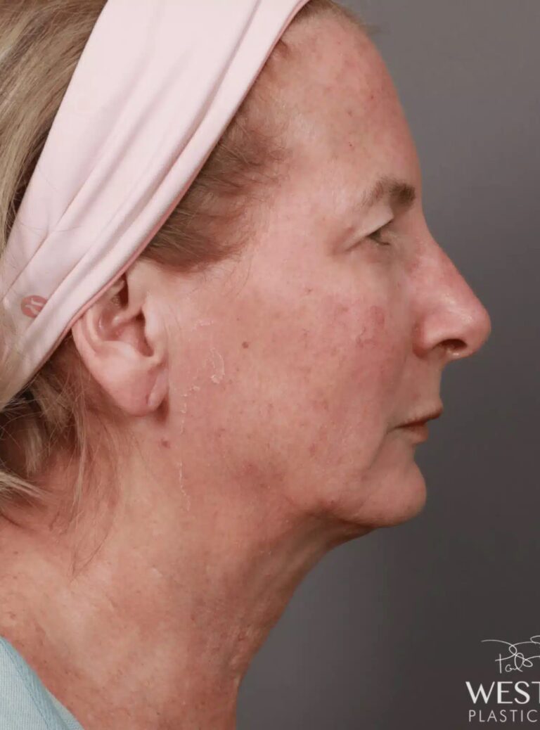 Before Image: Renuvion Tightening, Upper Blepharoplasty, CO2 Resurfacing, & Fat Grafting - right-side