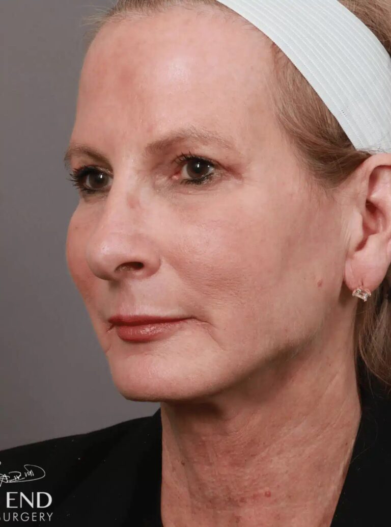 After Image: Renuvion Tightening, Upper Blepharoplasty, CO2 Resurfacing, & Fat Grafting - left-front-oblique
