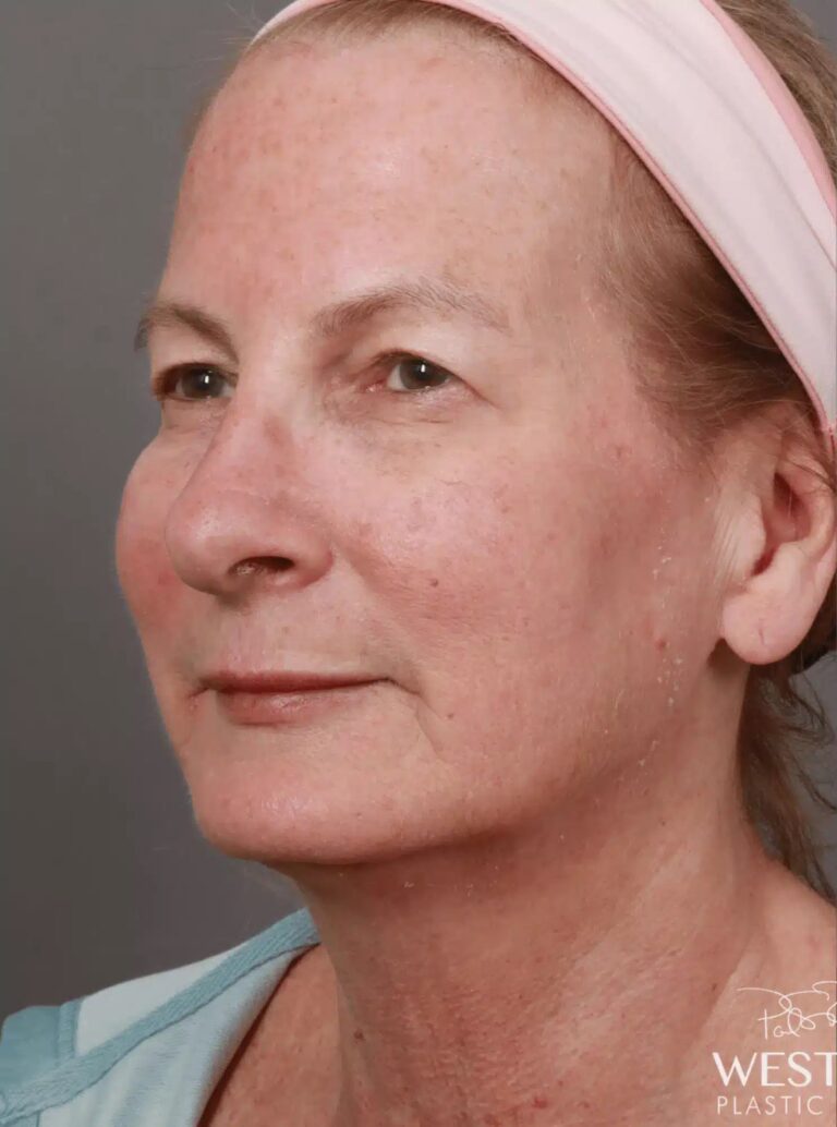 Before Image: Renuvion Tightening, Upper Blepharoplasty, CO2 Resurfacing, & Fat Grafting - left-front-oblique