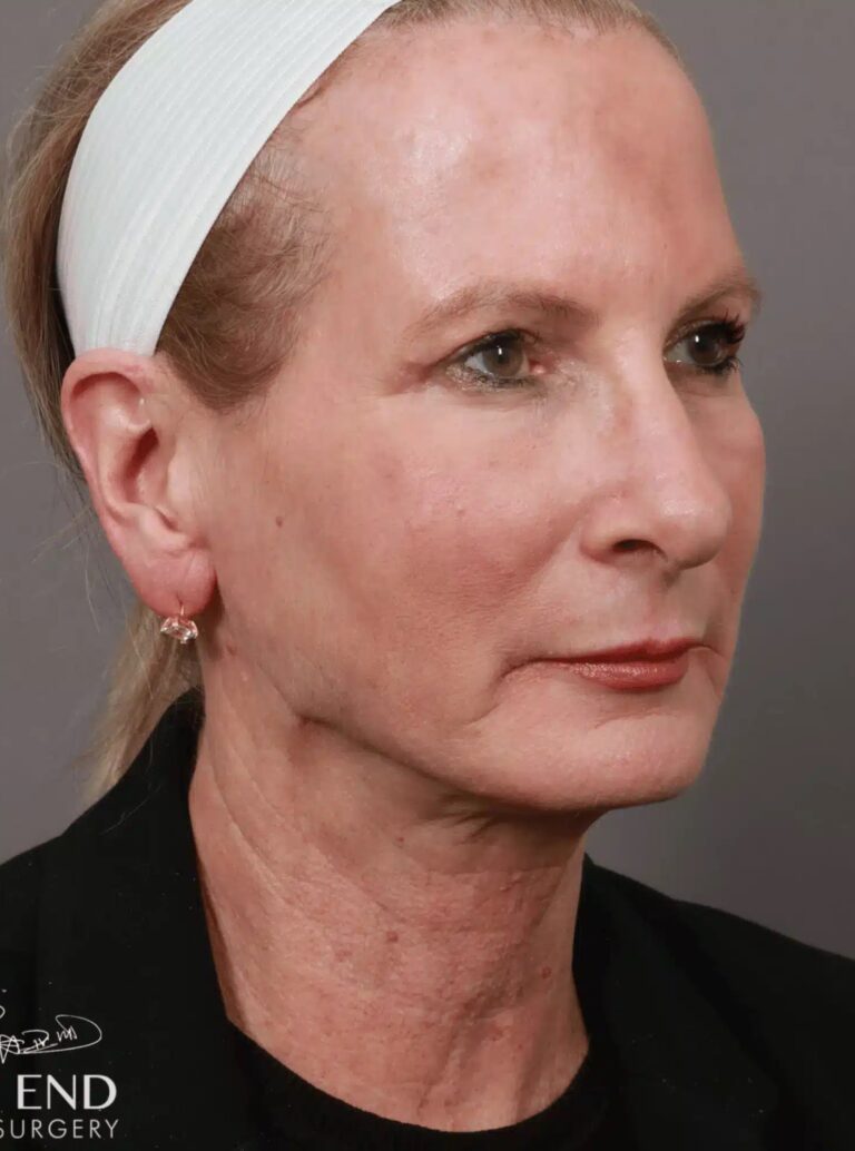 After Image: Renuvion Tightening, Upper Blepharoplasty, CO2 Resurfacing, & Fat Grafting - right-front-oblique