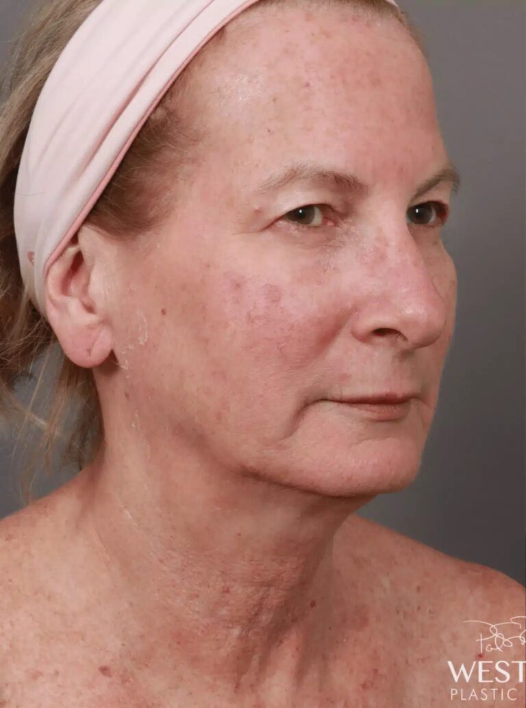 Before Image: Renuvion Tightening, Upper Blepharoplasty, CO2 Resurfacing, & Fat Grafting - right-front-oblique
