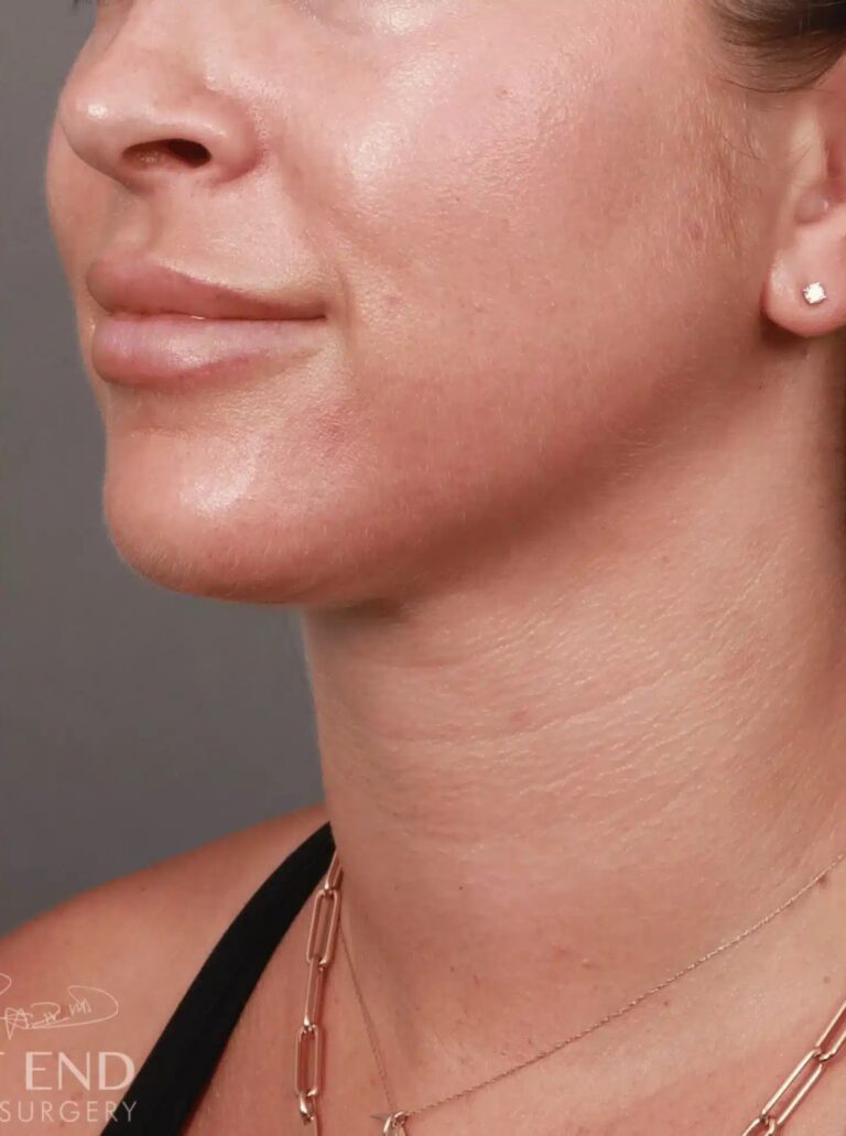 After Image: Liposuction of the Submental, Jawline, and Neck Region (5 Months Post-Op) - left-front-oblique