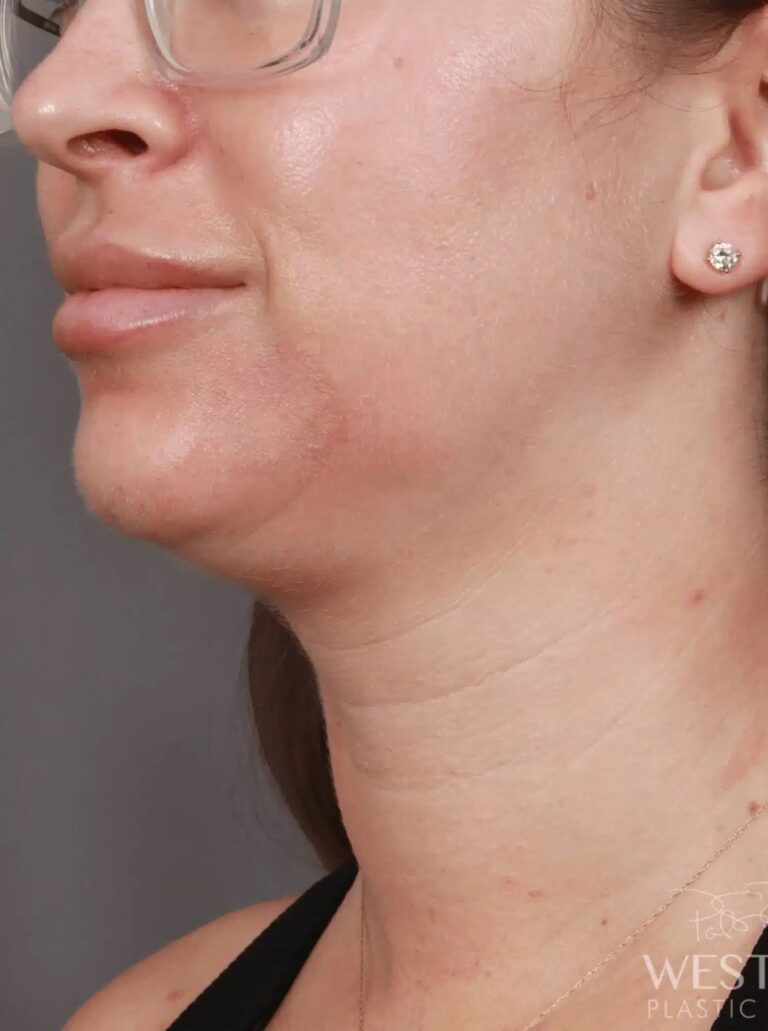 Before Image: Liposuction of the Submental, Jawline, and Neck Region (5 Months Post-Op) - left-front-oblique