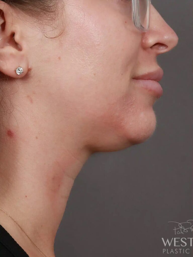 Before Image: Liposuction of the Submental, Jawline, and Neck Region (5 Months Post-Op) - right-side