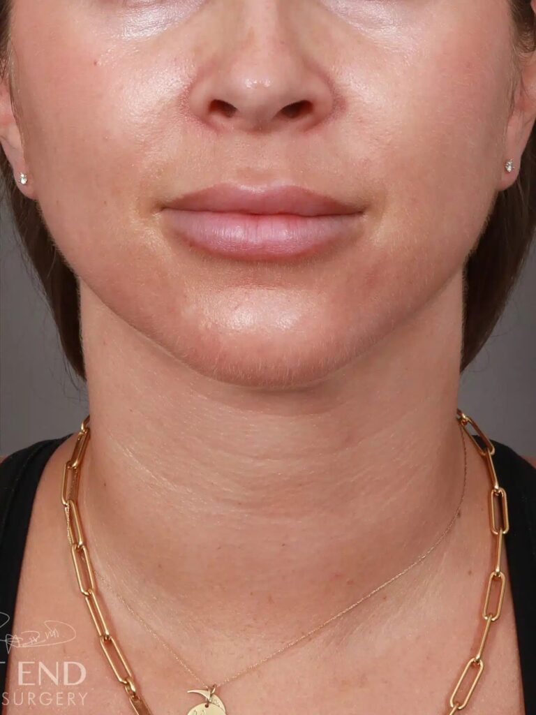 After Image: Liposuction of the Submental, Jawline, and Neck Region (5 Months Post-Op) - front
