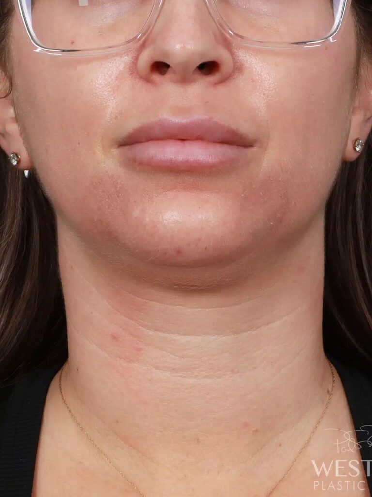 Before Image: Liposuction of the Submental, Jawline, and Neck Region (5 Months Post-Op) - front