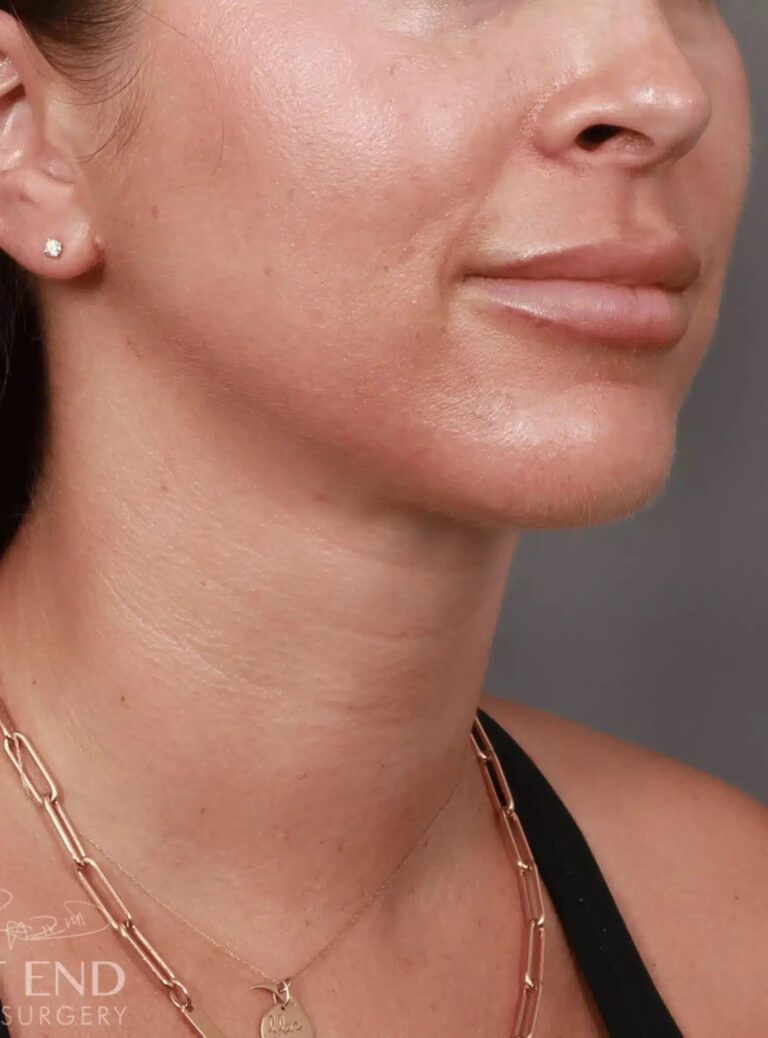After Image: Liposuction of the Submental, Jawline, and Neck Region (5 Months Post-Op) - right-front-oblique