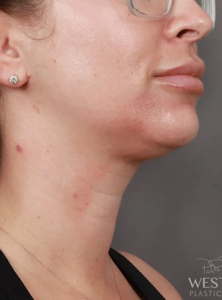 Before Image: Liposuction of the Submental, Jawline, and Neck Region (5 Months Post-Op) - right-front-oblique