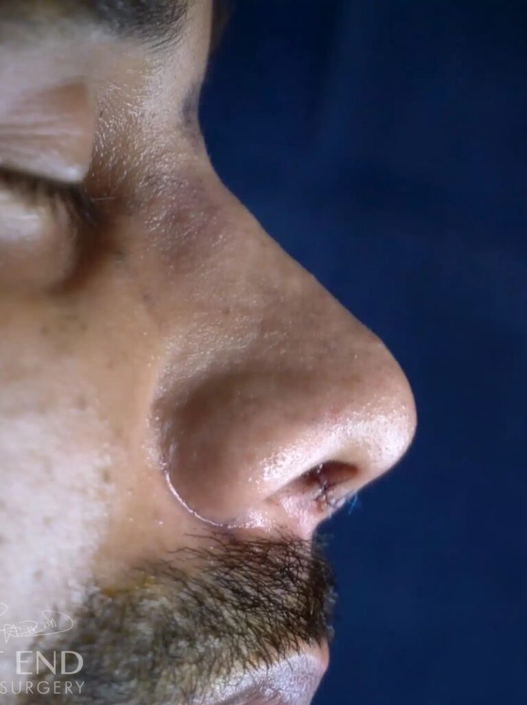After Image: Rhinoplasty - right-side