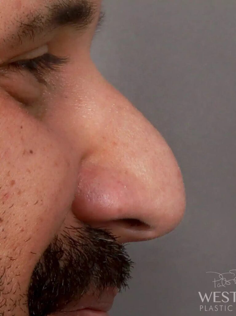 Before Image: Rhinoplasty - right-side