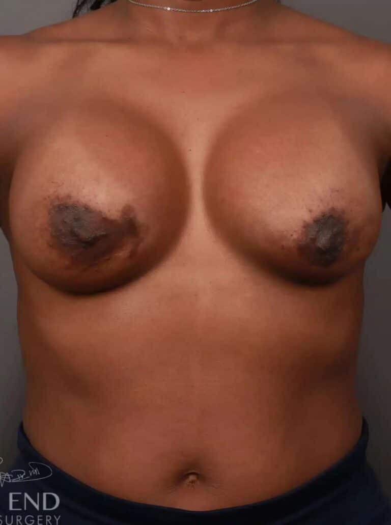 After Image: Breast Implant Exchange - front