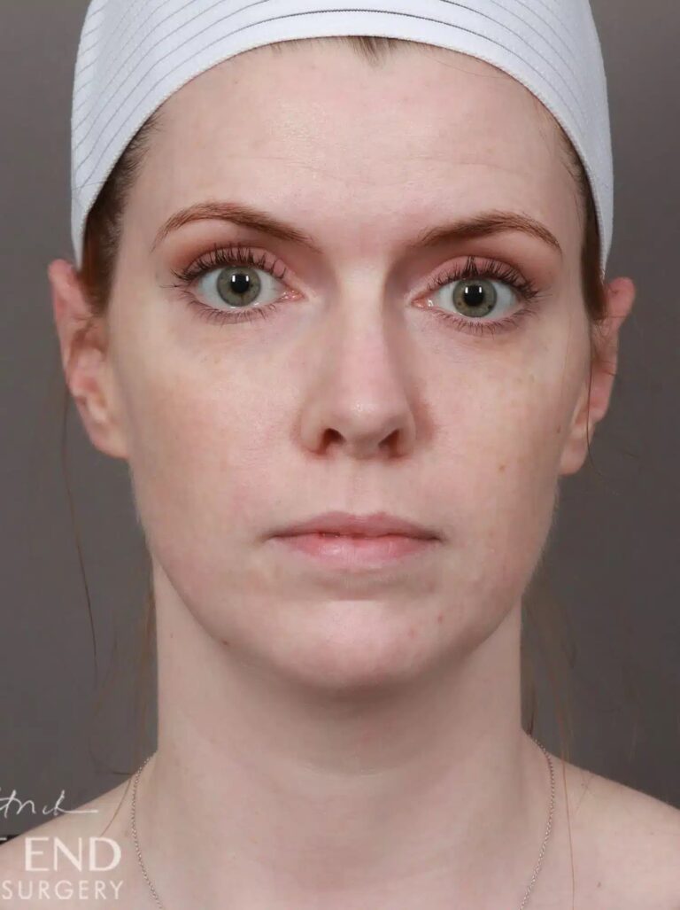 After Image: Otoplasty - front