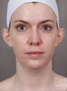 Before Image: Otoplasty