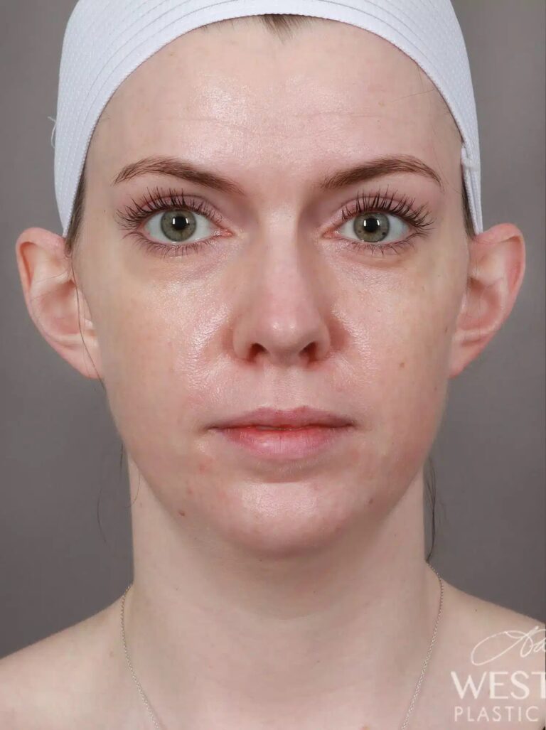 Before Image: Otoplasty - front