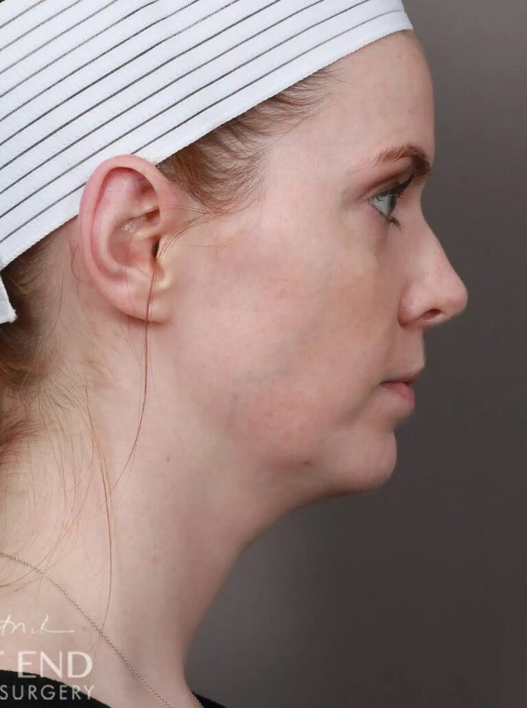 After Image: Otoplasty - right-side