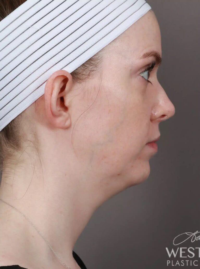 Before Image: Otoplasty - right-side