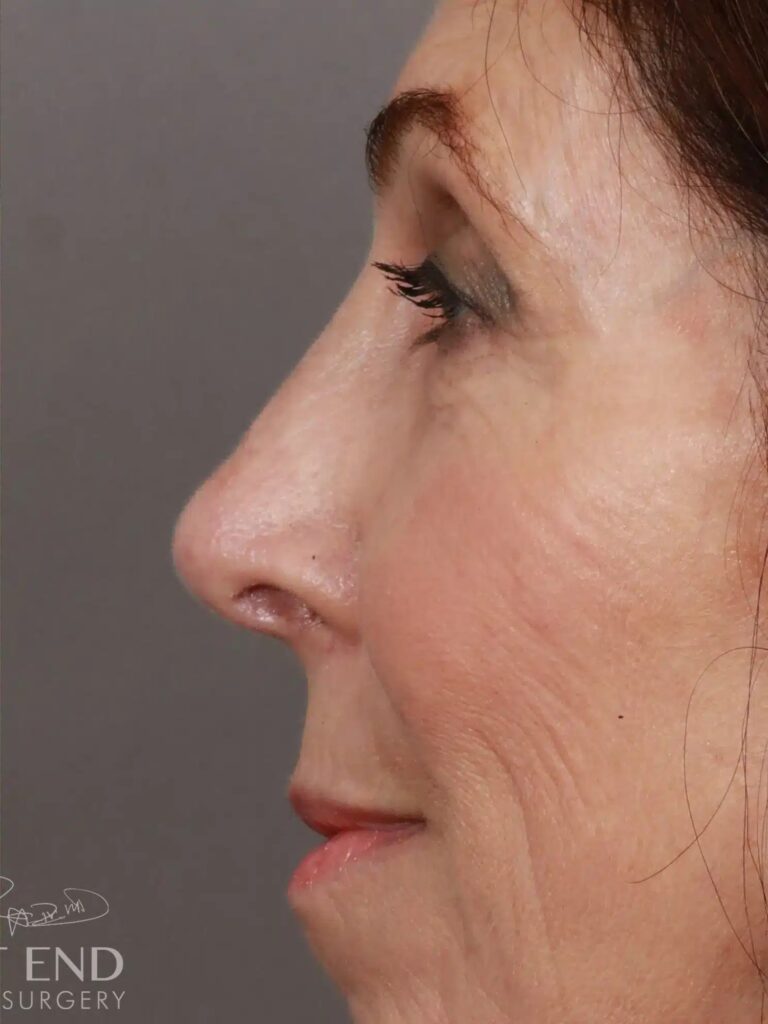 After Image: Rhinoplasty (1.5 Months Post-Op) - left-side