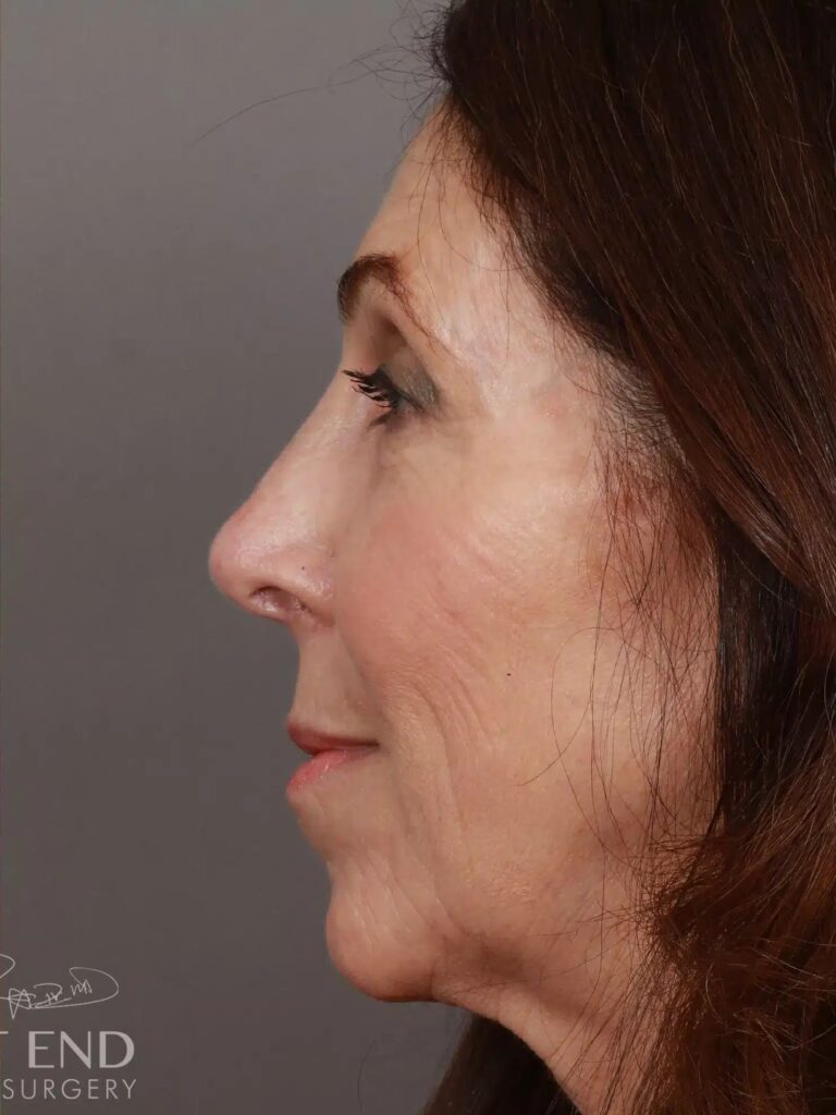 After Image: Rhinoplasty (1.5 Months Post-Op) - left-side