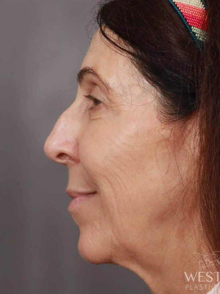 Before Image: Rhinoplasty (1.5 Months Post-Op) - left-side