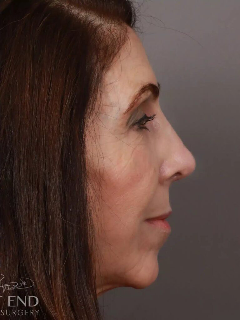 After Image: Rhinoplasty (1.5 Months Post-Op) - right-side