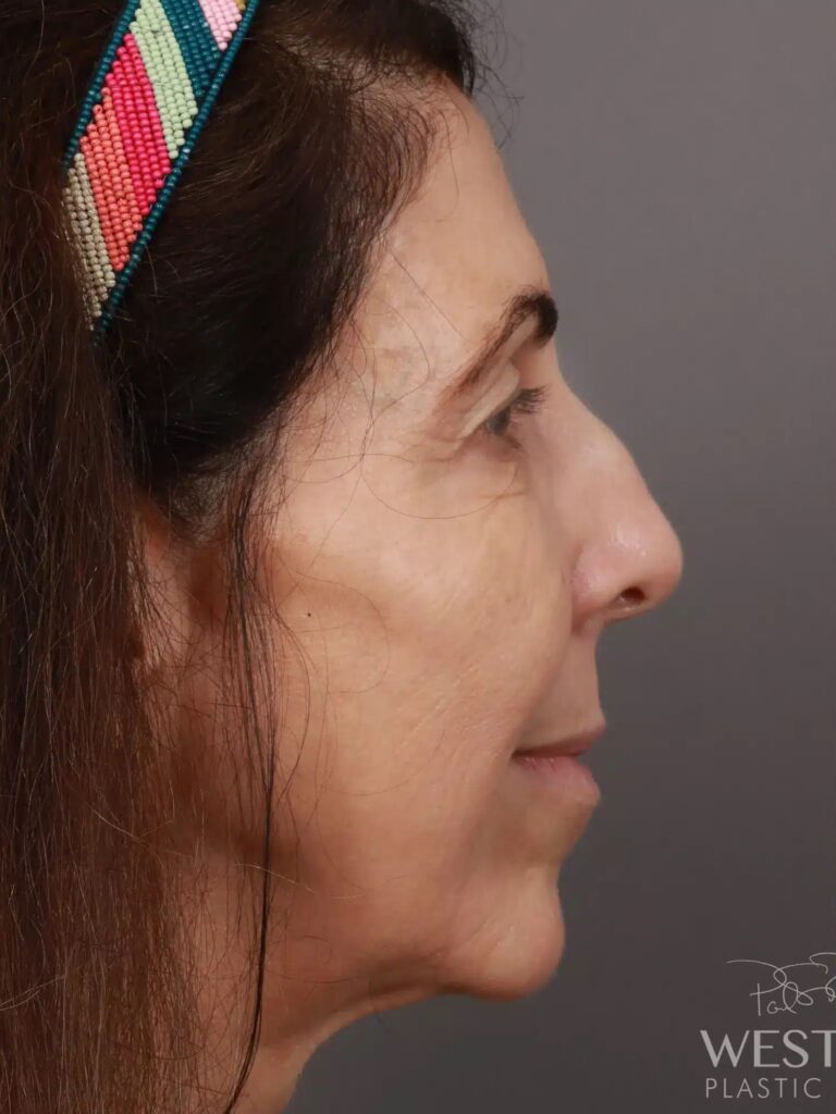 Before Image: Rhinoplasty (1.5 Months Post-Op) - right-side