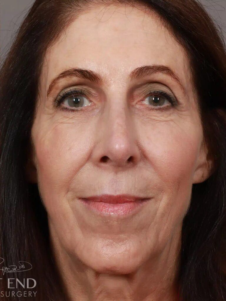 After Image: Rhinoplasty (1.5 Months Post-Op) - front
