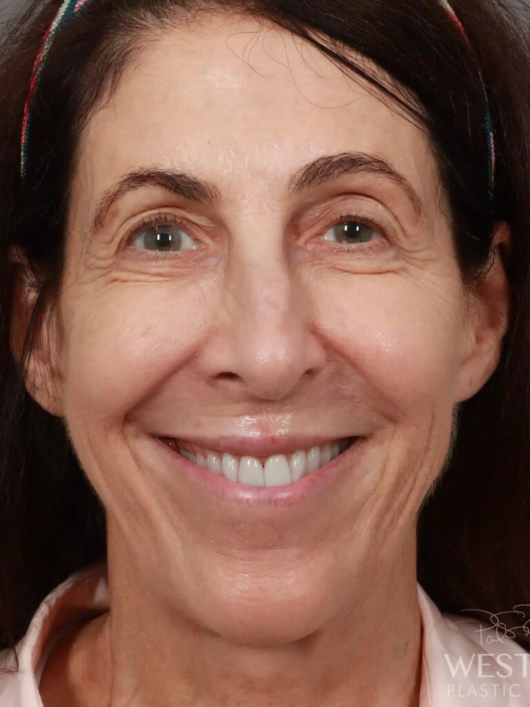 Before Image: Rhinoplasty (1.5 Months Post-Op) - front