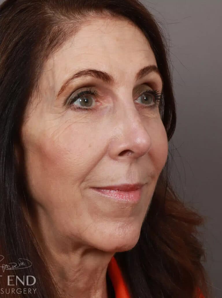 After Image: Rhinoplasty (1.5 Months Post-Op) - right-front-oblique