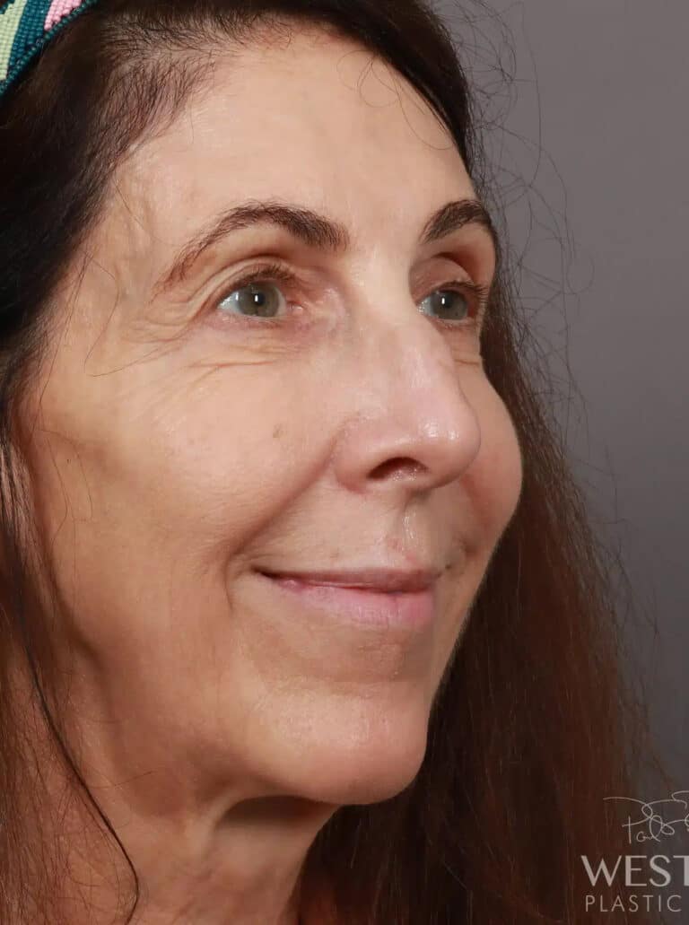 Before Image: Rhinoplasty (1.5 Months Post-Op) - right-front-oblique