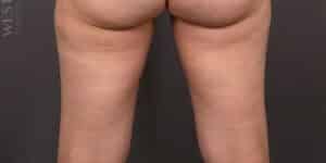 After Image: CoolSculpting
