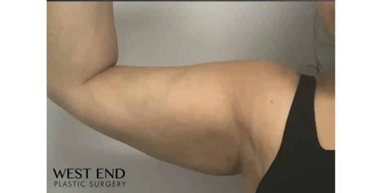 After Image: CoolSculpting - front