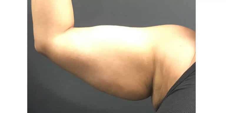 Before Image: CoolSculpting - front