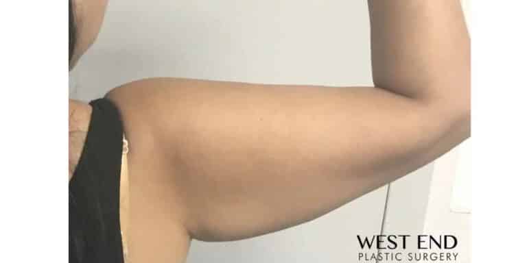 After Image: CoolSculpting - back