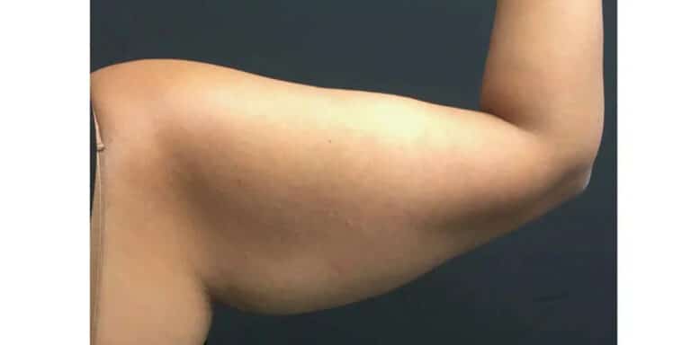 Before Image: CoolSculpting - back