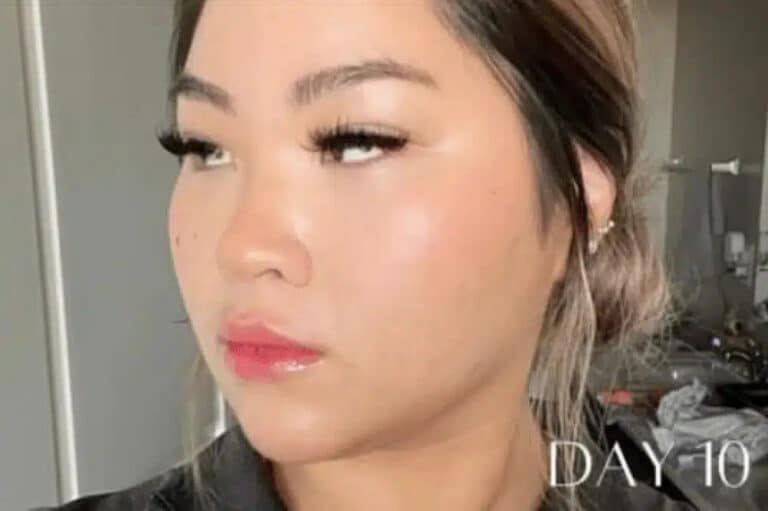 After Image: Microneedling RF & CO2 CoolPeel - left-front-oblique