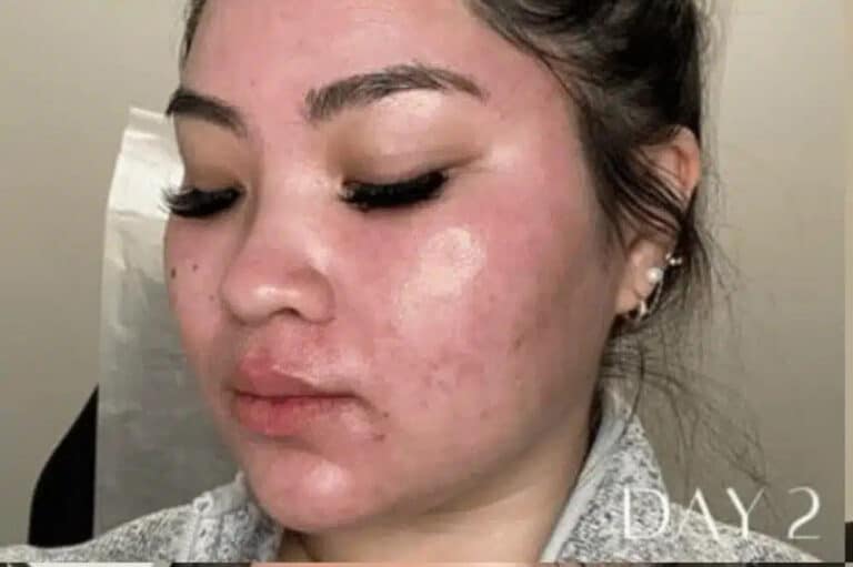 Before Image: Microneedling RF & CO2 CoolPeel - left-front-oblique