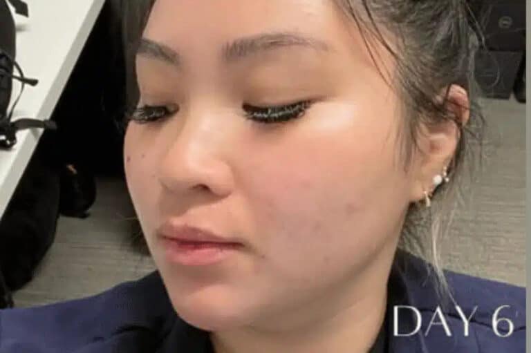 Before Image: Microneedling RF & CO2 CoolPeel - left-front-oblique