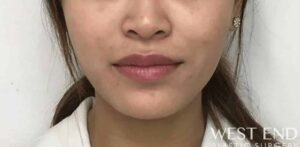 After Image: Botox in the Masseter Muscle (Jaw Clenching)