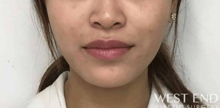 After Image: Botox in the Masseter Muscle (Jaw Clenching) - front