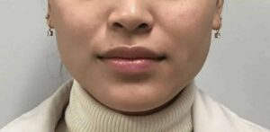 Before Image: Botox in the Masseter Muscle (Jaw Clenching)