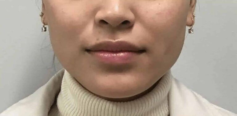 Before Image: Botox in the Masseter Muscle (Jaw Clenching) - front
