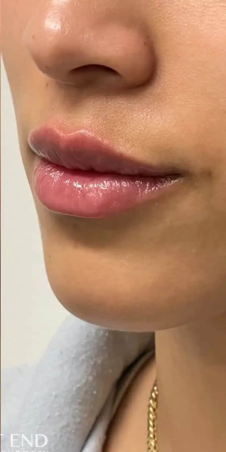 After Image: Lip Filler - left-front-oblique