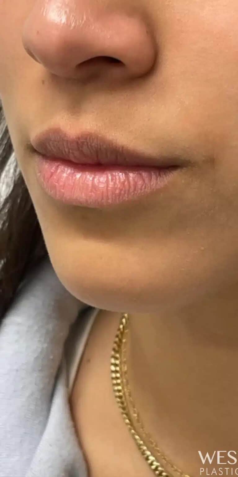 Before Image: Lip Filler - left-front-oblique