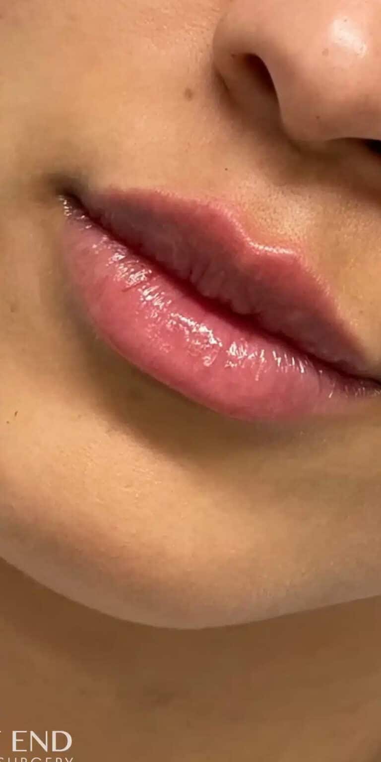 After Image: Lip Filler - front