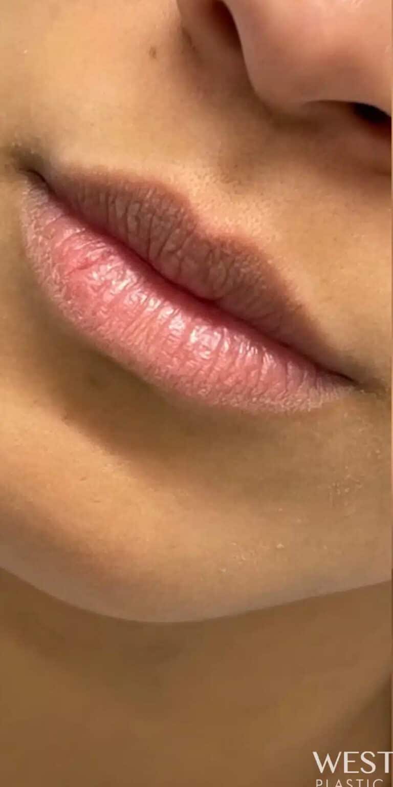 Before Image: Lip Filler - front